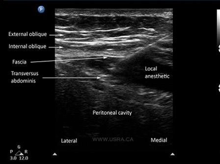 Регионарная анестезия под контролем УЗИ